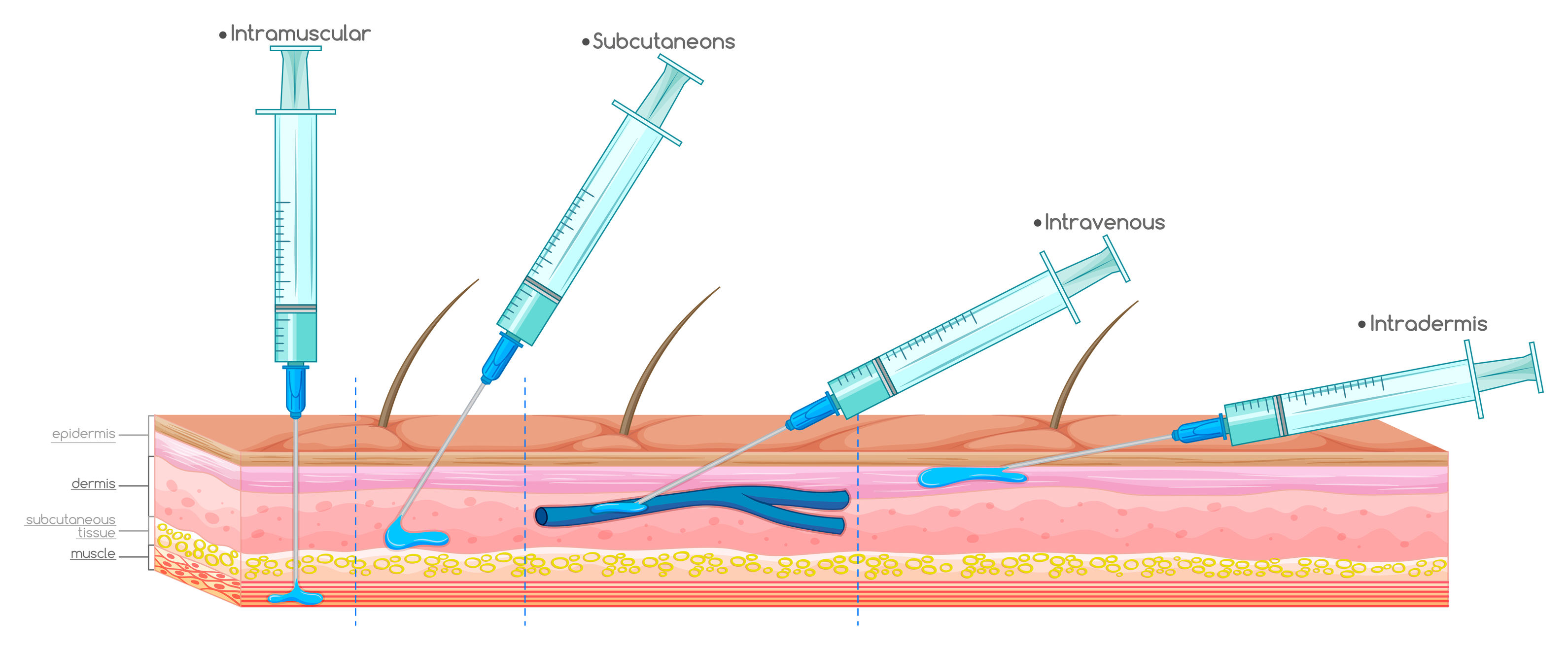 intradermal injection